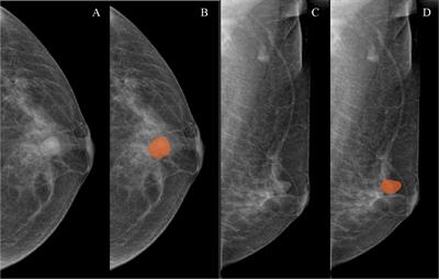 Radiomics Based on Digital Mammography Helps to Identify Mammographic Masses Suspicious for Cancer